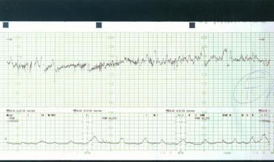CTG 14.7