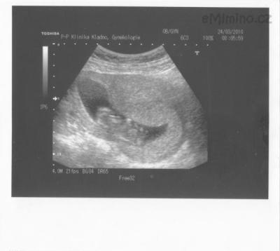foto miminka 13 týden.jpg