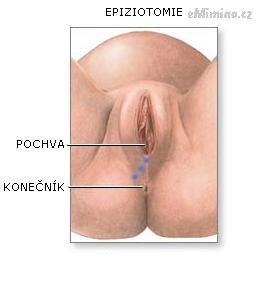 epiziotomie.jpg