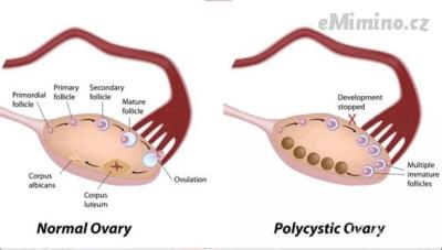 pcos.png