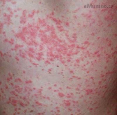 guttate-psoriasis-pictures-2.jpg