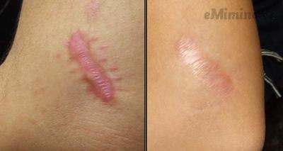 10-natural-remedies-to-remove-keloids (1).png