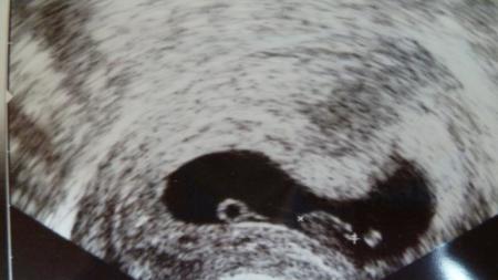 pregnancy