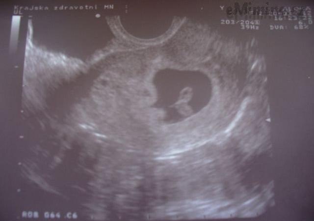 7. týden těhotenství, ultrazvuk embrya v děloze