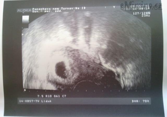 Ultrazvuk miminka v 8. týdnu těhotenství