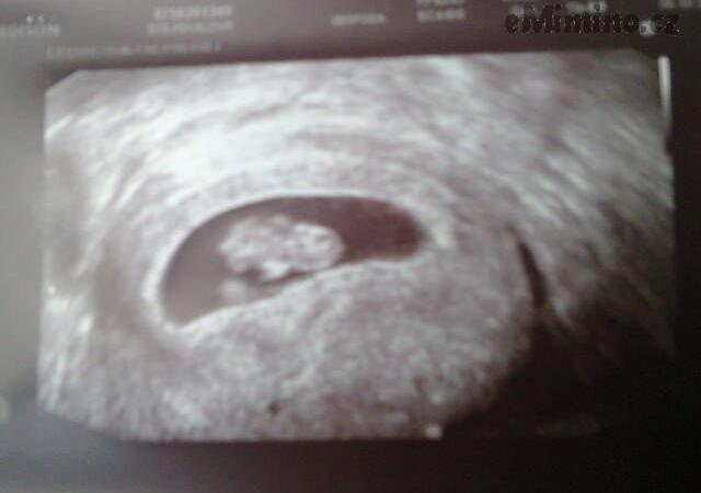 9. týden těhotenství, ultrazvuk