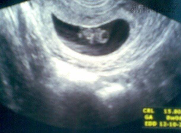 Ultrazvuk miminka v 8. týdnu těhotenství