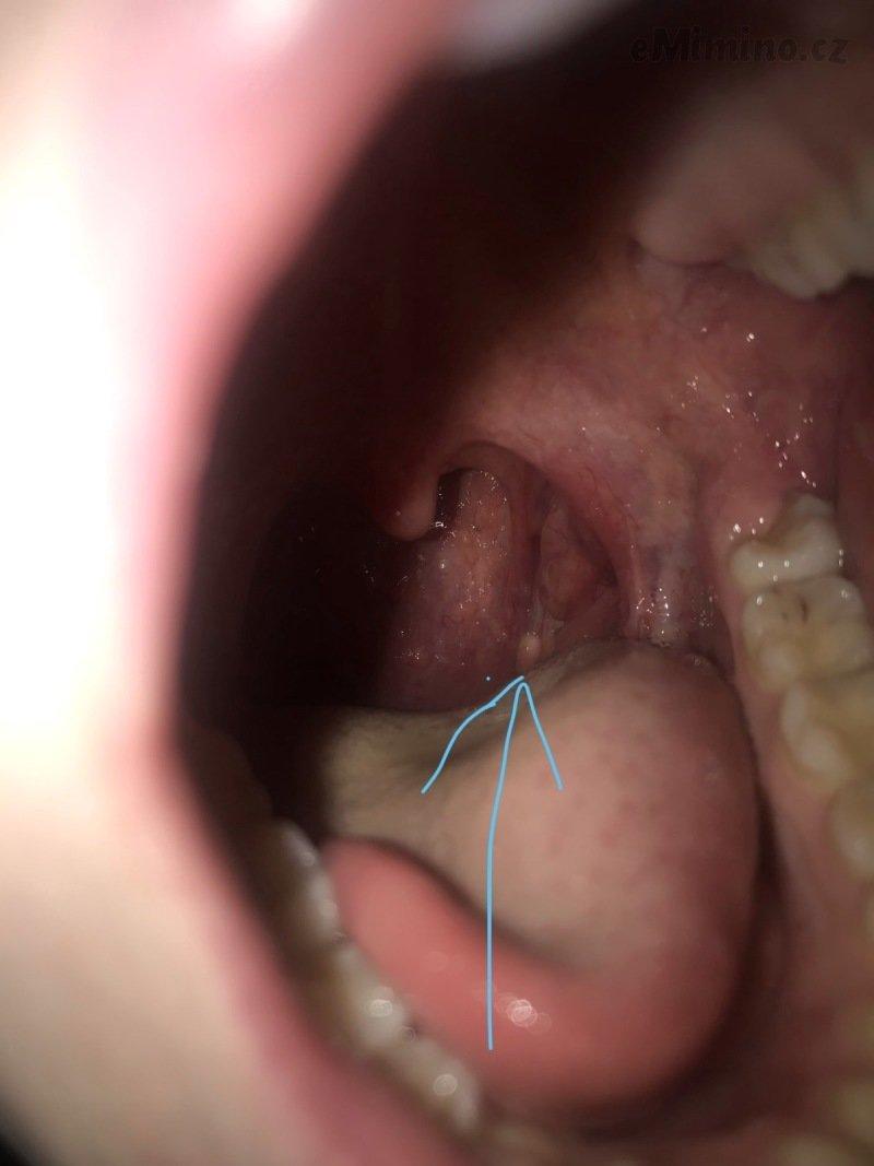 Co to jsou polypy v krku?