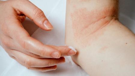 Atopický ekzém pod kontrolou: Pomůže promazávání kůže a omezení kontaktu s alergeny