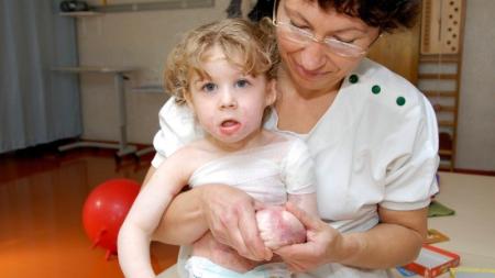 Vteřina nepozornosti a malá Lucinka bojovala o život. Jizvy z popálenin jí zůstanou na celý život