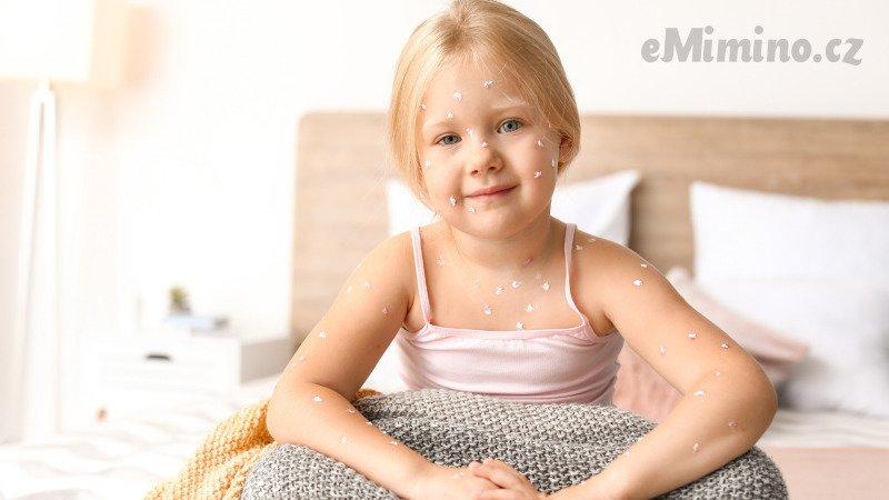 Neštovice se nejvíce šíří v dětském kolektivu. Zdroj: Canva