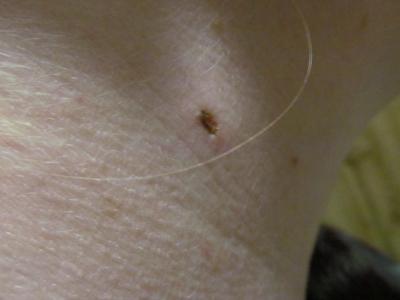 Zdravotní potíže dospělých | Dermatolog poškodil znaménka