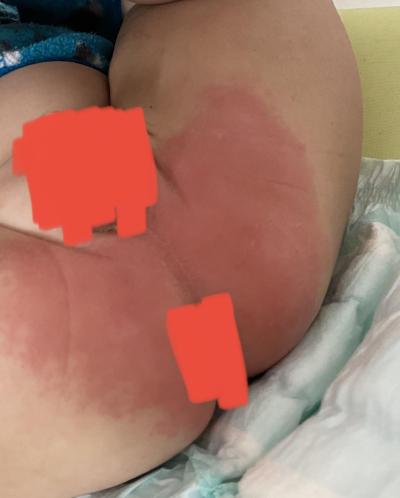 Dětské nemoci | Vyrážka u batolátka?