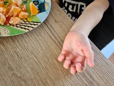 Dětské nemoci | Červené fleky na chodidle