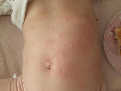Alergie a ekzémy | Vyrážka u tříleté dcery