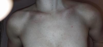 Alergie a ekzémy | Potničky u dospělých?
