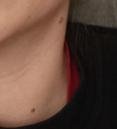 Zdravotní potíže dospělých | Dermatolog poškodil znaménka