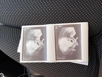 Těhotenství | Nejsou na fotce z ultrazvuku dvojčátka?