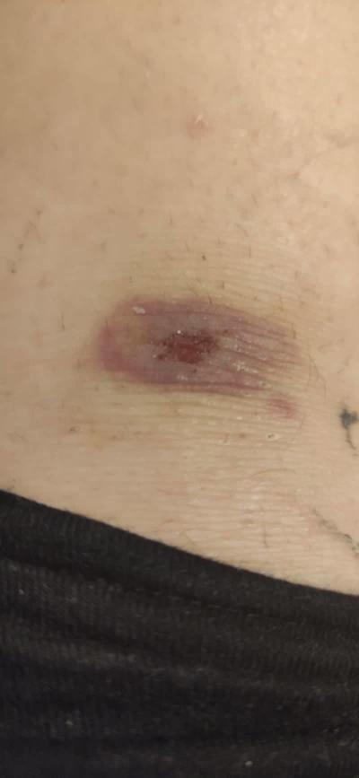Alergie a ekzémy | Divný flek, co to může být?