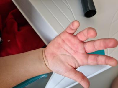Dětské nemoci | Červené fleky na dlanich