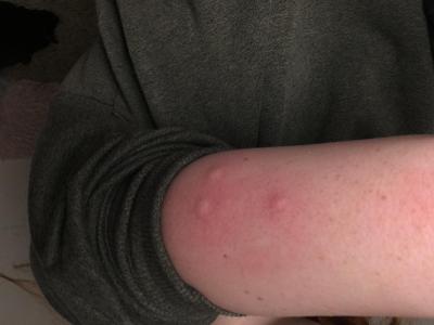 Alergie a ekzémy | Jedná se o štěnice ?