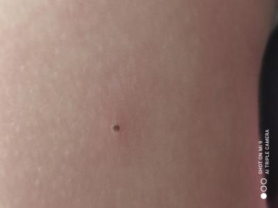 Dětské nemoci | Co to má dcéra na ruce