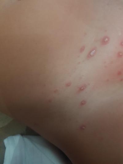 Dětské nemoci | Pupínky, podbřišek, slabiny