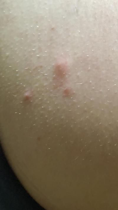 Zdravotní potíže dospělých | Akné nebo štípnutí