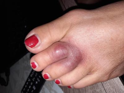 Zdravotní potíže dospělých | Modrá noha u dospělého člověka