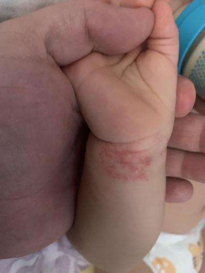 Alergie a ekzémy | Atopický ekzém – klub, sdružení – radíme si