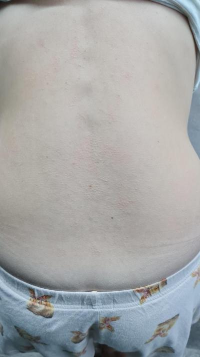 Alergie a ekzémy | Vyrážka/pupínky, co je to?