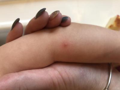 Alergie a ekzémy | Pupínky na tváři a těle