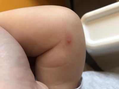 Alergie a ekzémy | Pupínky na tváři a těle