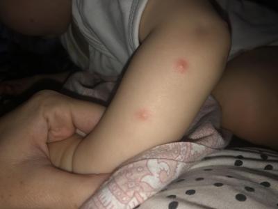 Dětské nemoci | Pupínky u 8 měsíčního miminka