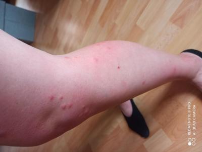 Alergie a ekzémy | Štípance od komárů