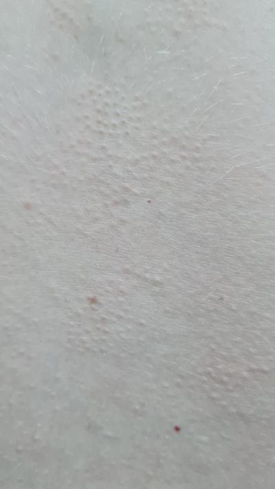 Alergie a ekzémy | Vyrážka/pupínky, co je to?