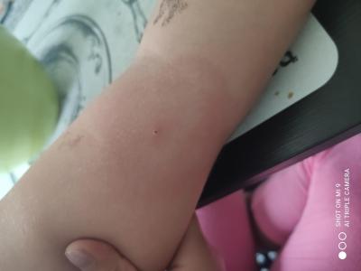 Dětské nemoci | Co to má dcéra na ruce