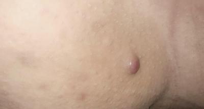 Zdravotní potíže dospělých | Puchýř na stehně (foto)