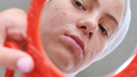 Můj boj s tělem po vysazení antikoncepce: Hledání cesty zpět k sobě samé, PCOS