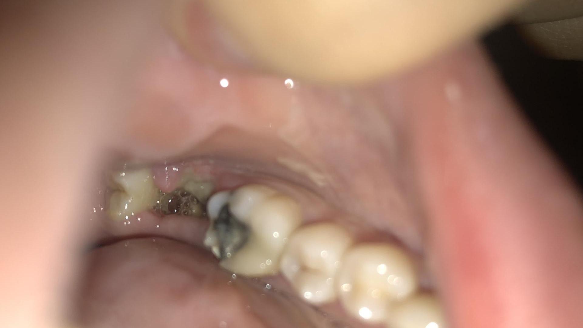 Jak dostat zánět ze zubu?