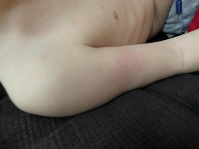 Alergie a ekzémy | Kopřivka po covidu