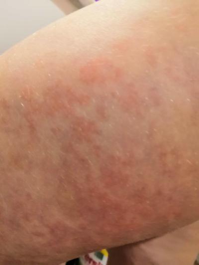 Alergie a ekzémy | Vyrážka na stehně u 4 letého