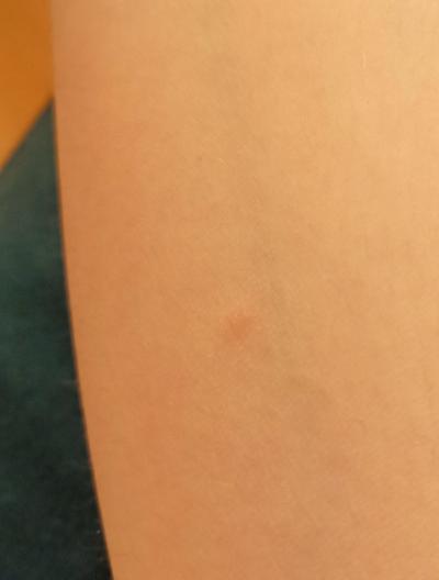 Zdravotní potíže dospělých | Malé svědivé flíčky