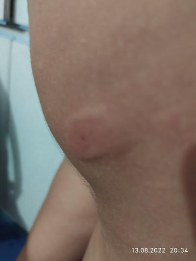 Alergie a ekzémy | Co je to za stipanec?