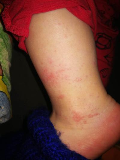 Alergie a ekzémy | Ekzém u 18měsíčního dítěte