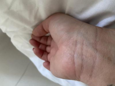 Alergie a ekzémy | Svědivé drobné pupínky