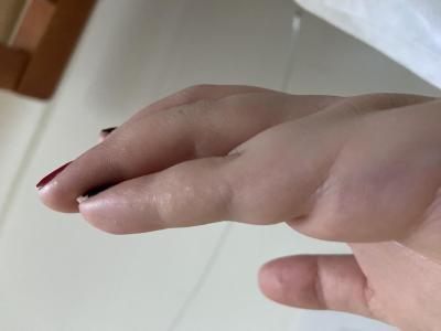 Alergie a ekzémy | Svědivé drobné pupínky