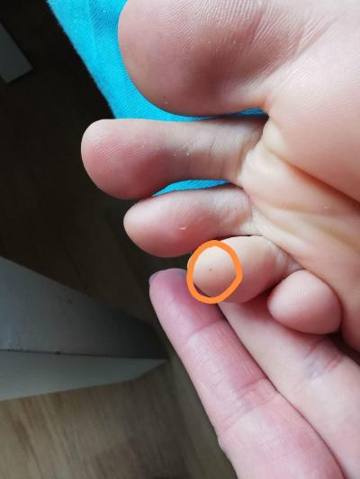 Zdravotní potíže dospělých | Pihy na prstech u nohou