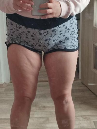 Gynekologické potíže | 7cm Cysta na vaječníku