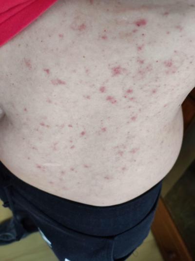 Zdravotní potíže dospělých | Vyrážka u dospělé osoby